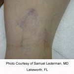 Laser vein removal before